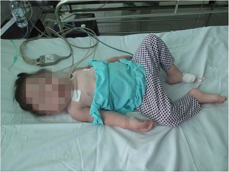 Một trẻ 5 tuổi vô tình bị hóc dị vật là con bu- loong sau khi được nội soi lấy ra.