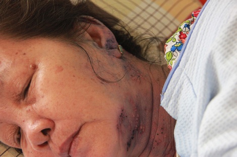 Bà Nguyễn Thị Bé đau đớn khi bị kiến ba khoang cắn và làm phồng rộp da trong lúc điều trị bệnh huyết áp.