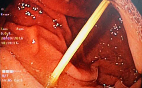 Dị vật là đoạn tăm tre dài 7cm nằm trong dạ dày bệnh nhân và sau khi được nội soi gắp ra.