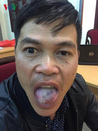 Sau khi thả nạn nhân, Quang đã vào bệnh viện khâu lưỡi bị nạn nhân cắn gần đứt