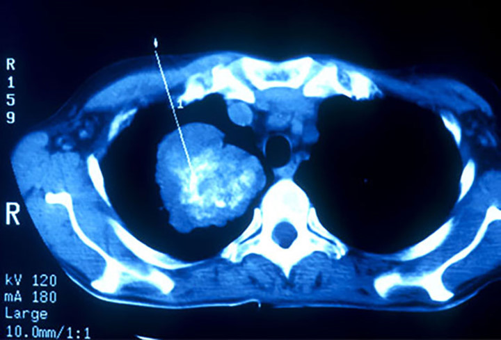4. Bạn có thể kiểm tra được không? Một loại hình chụp CT được gọi là xoắn ốc CT có thể phát hiện ung thư phổi.