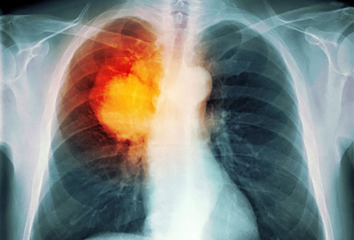 5. Chẩn đoán: Nếu bác sĩ của bạn nghĩ rằng bạn có thể bị ung thư phổi thì bạn sẽ được chụp X-quang ngực hoặc làm xét nghiệm đờm. Nếu một trong hai thử nghiệm này chưa cho bạn biết có  mắc bệnh ung thư hay không, có thể bạn sẽ cần sinh thiết.