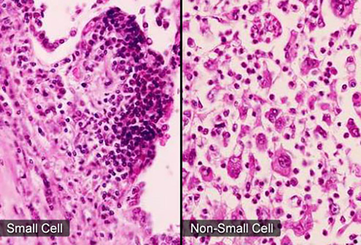 7. Hai loại chính: Thứ nhất là Ung thư phổi tế bào nhỏ (SCLC), phát triển rất nhanh và nó có thể lây lan rất nhanh đến các bộ phận khác của cơ thể. Thứ hai là Ung thư phổi tế bào không nhỏ (NSCLC), phát triển chậm hơn và phổ biến hơn. Loại NSCLC là loại thường hay xảy ra nhất—85% tất cả các trường hợp chẩn đoán ung thư phổi đều thuộc loại NSCLC.
