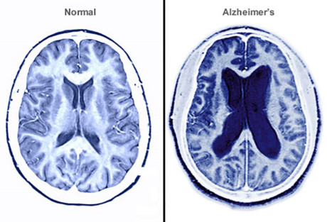Chuyện gì sẽ xảy ra với não?  Bệnh Alzheimer gây chết tế bào thần kinh và mất mô trong não. Khi bệnh trở nên tồi tệ hơn, mô não sẽ co lại và các vùng có chứa dịch não tủy trở nên lớn hơn. Điều này gây tổn hại đến trí nhớ, lời nói và sự nhận thức.