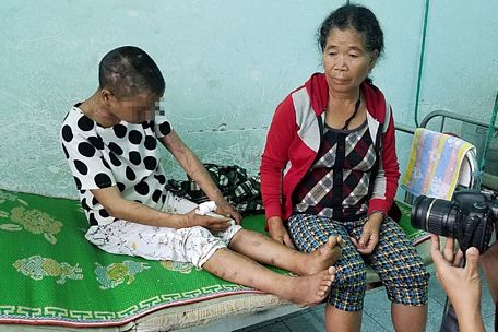Y Nhiêu đang điều trị tại Trung tâm Y tế huyện Đắk Glei (Kon Tum) cùng mẹ. Ảnh: ĐÌNH VĂN