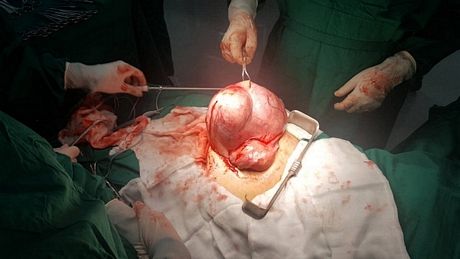 Khối u xơ tử cung nặng gần 3kg, gây biến chứng cho bệnh nhân.