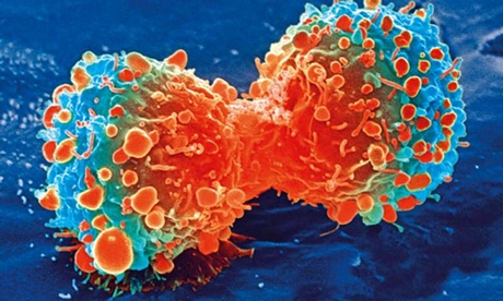 Tế bào ung thư trong quá trình phân chia.