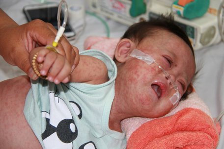 Nhiều trẻ bị bệnh sởi biến chứng nặng phải nhập viện Bệnh viện Nhi đồng 1 TP Hồ Chí Minh.