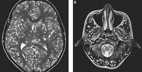 Kết quả chụp MRI cho thấy chàng trai có nhiều nang sán trong vỏ não (hình bên trái là các chấm trắng). Các tổn thương cũng được tìm thấy trong thân não và tiểu não của anh ta (nhìn bên phải). (Nguồn: dailymail.co.uk)