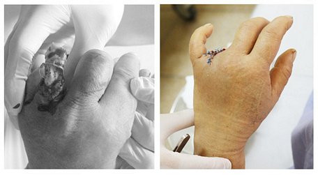 Hình ảnh ngón 4 tay trái bệnh nhân trước phẫu thuật và sau phẫu thuật (Ảnh: bác sĩ cung cấp)