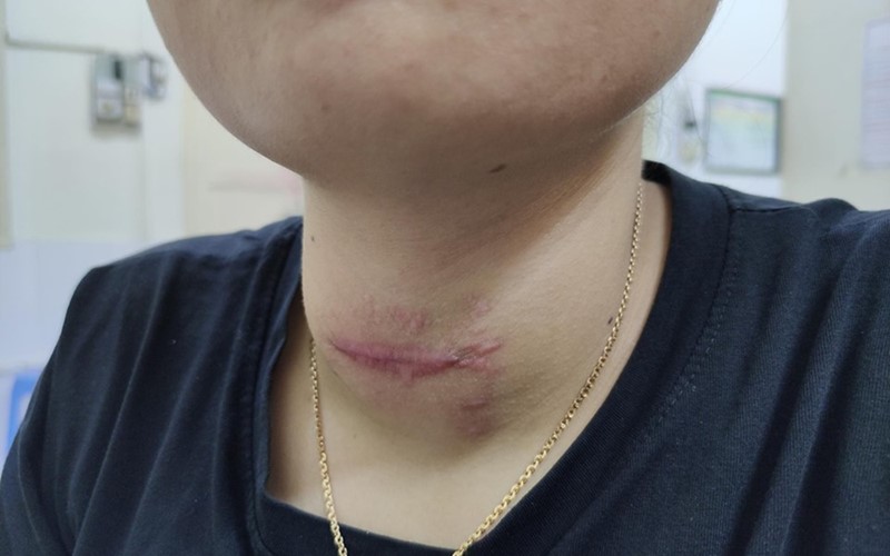 Vết sẹo trên cổ chị L. sau khi bị nhiễm trùng. (Ảnh do BV cung cấp)