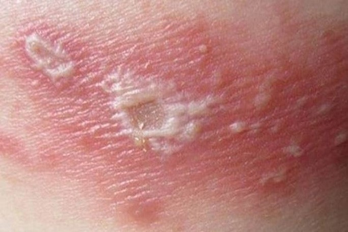 Da có thể bị tổn thương nghiêm trọng nếu bị dính nọc của kiến ba khoang