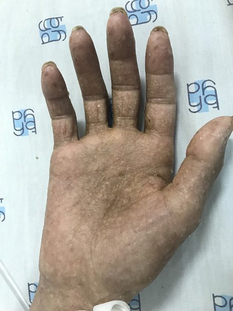 Bàn tay hóa sừng của bệnh nhân trước điều trị