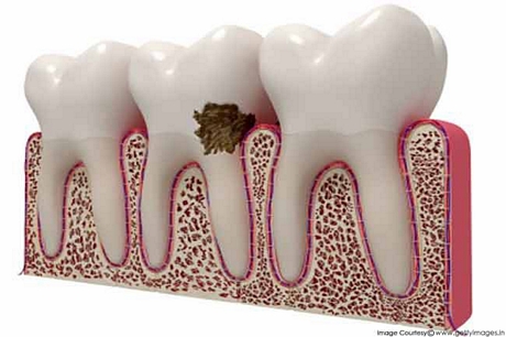 Vi khuẩn: Khoang miệng chứa vô số vi khuẩn, mà phần lớn là vô hại. Việc vệ sinh răng miệng tốt sẽ giữ các vi khuẩn trong tầm kiểm soát. Tuy vậy, nếu vệ sinh răng miệng kém, lượng vi khuẩn sẽ tăng đến mức gây nhiễm khuẩn khoang miệng, như sâu răng hay viêm lợi.