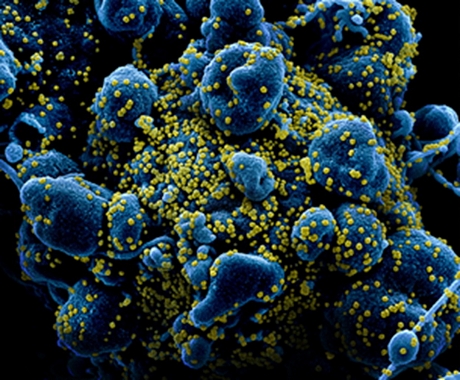 Một tế bào chết rụng bị nhiễm nặng SARS-CoV-2 (màu sáng). Hình ảnh đã xử lý màu cho thấy hàng trăm vi rút bám dày đặc trên bề mặt tế bào người, được lấy từ một bệnh nhân COVID-19 ở Mỹ, khi tế bào rơi vào tình trạng chết rụng.Ảnh: NIAID/ IFL Science