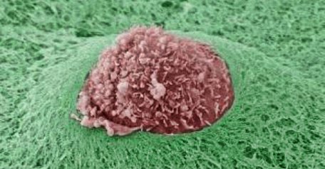Ảnh hiển vi điện tử quét mô tả hình ảnh tế bào ung thư vú (màu sậm ở giữa) trong lớp Matrigel (màu xanh) rất dày.