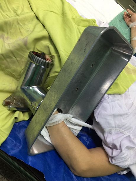 Bệnh nhân được đưa vào BVĐK Trung ương Cần Thơ cấp cứu hôm 27/11, cùng với chiếc máy xay thịt đang nghiến chặt cánh tay trái.
