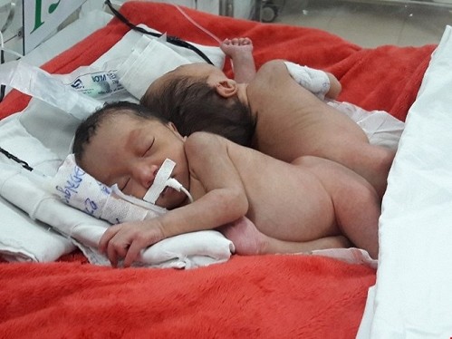 Hai bé sơ sinh dính liền phần mông đang được chăm sóc tại Bệnh viện Nhi đồng 2. Ảnh: Hà Phượng 