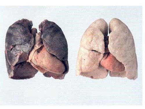 Hút thuốc lá là một trong những nguyên nhân hàng đầu dẫn tới ung thư phổi