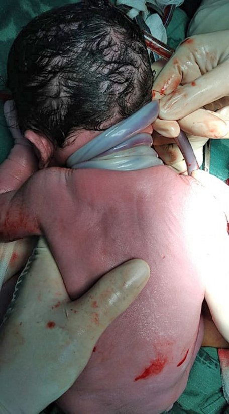 BVĐK Trung ương TP Cần Thơ vừa phẫu thuật cấp cứu thành công trường hợp hiếm gặp: suy thai cấp do dây rốn quấn chặt cổ tới 4 vòng.