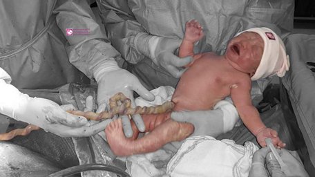 Bệnh viện Quốc tế Phương Châu (TP Cần Thơ) phẫu thuật thành công bé trai bị xoắn dây rốn.