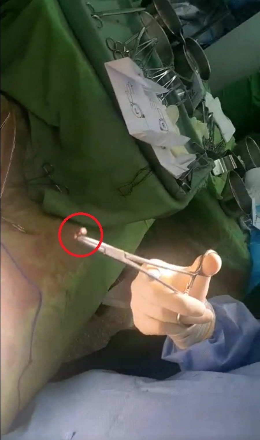 Viên đạn lấy ra sau phẫu thuật.