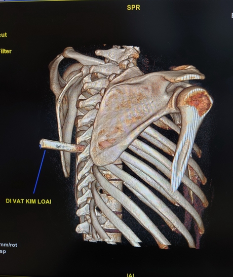 Hình ảnh CT mũi dao đâm vào cột sống bệnh nhân.