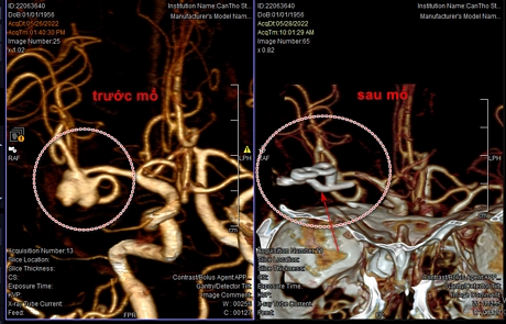 Túi phình mạch máu não của bệnh nhân đã bị vỡ khi huyết áp tăng cao (hình bên trái).