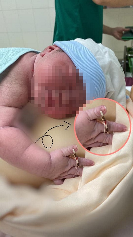 Sau khi bé chào đời, các bác sĩ đã cho bé cầm vòng tránh thai để chụp ảnh kỷ niệm.