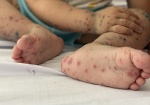 TP Hồ Chí Minh: Xuất hiện chủng virus gây bệnh tay chân miệng nặng ở trẻ em