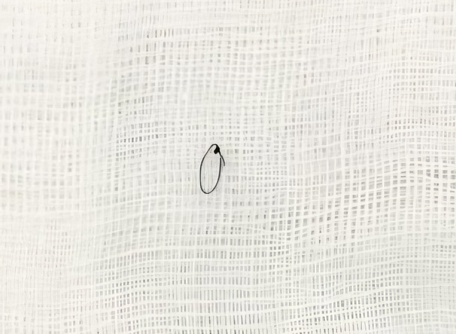 Dị vật là sợi chỉ được lấy ra.