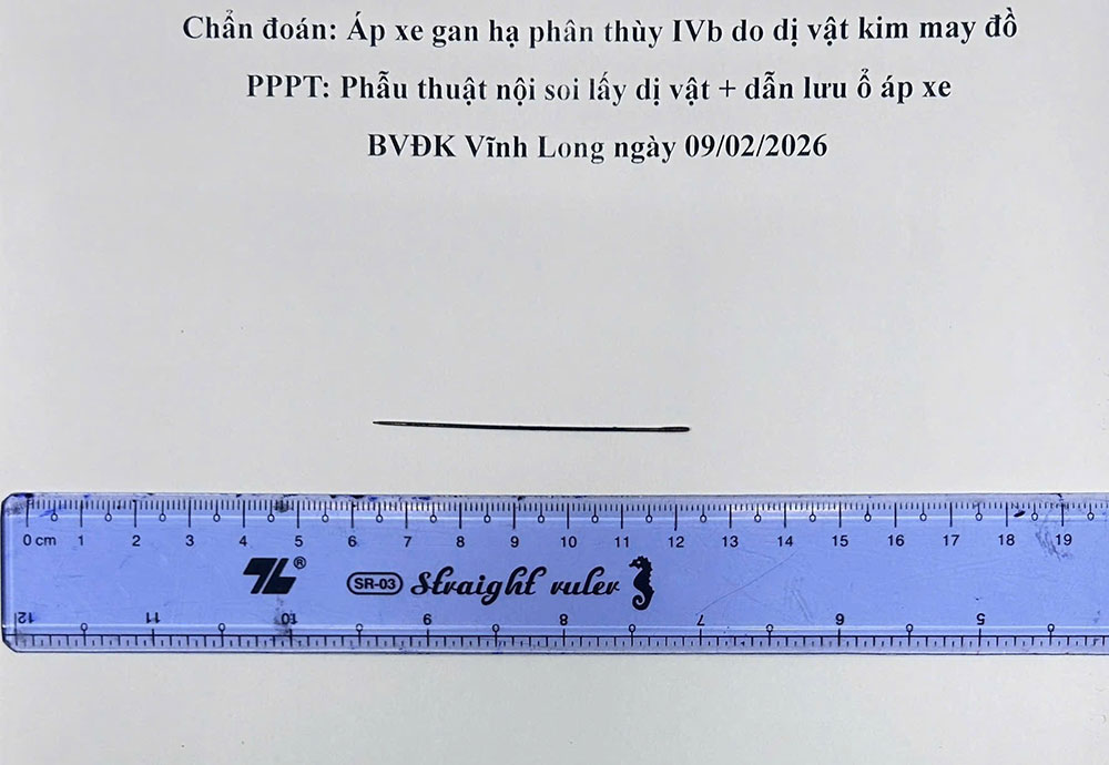 Dị vật kim loại gây ra áp xe gan.