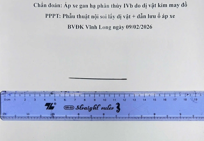 Phẫu thuật nội soi lấy dị vật là kim may trong gan