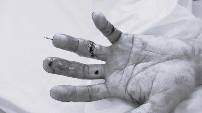  Tình trạng bàn tay bệnh nhân sau mổ 