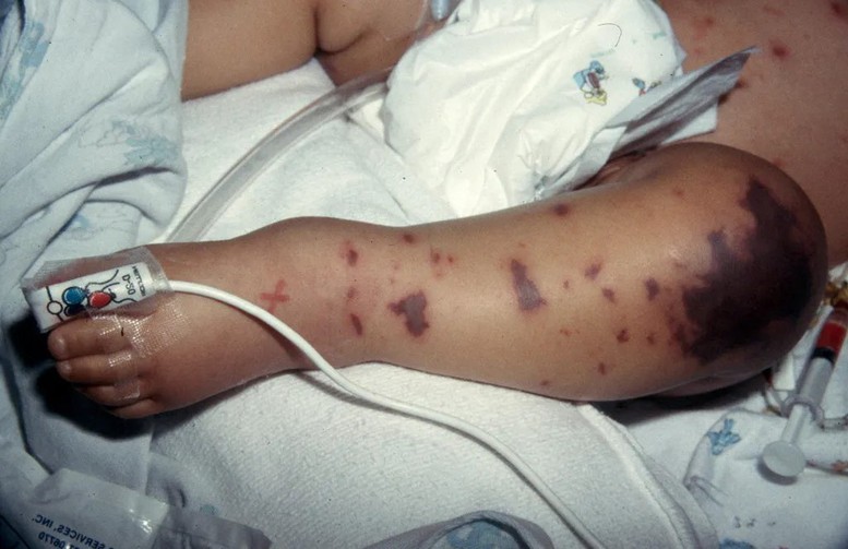 Dấu hiệu ban điển hình trên da của trẻ mắc viêm màng não mô cầu

