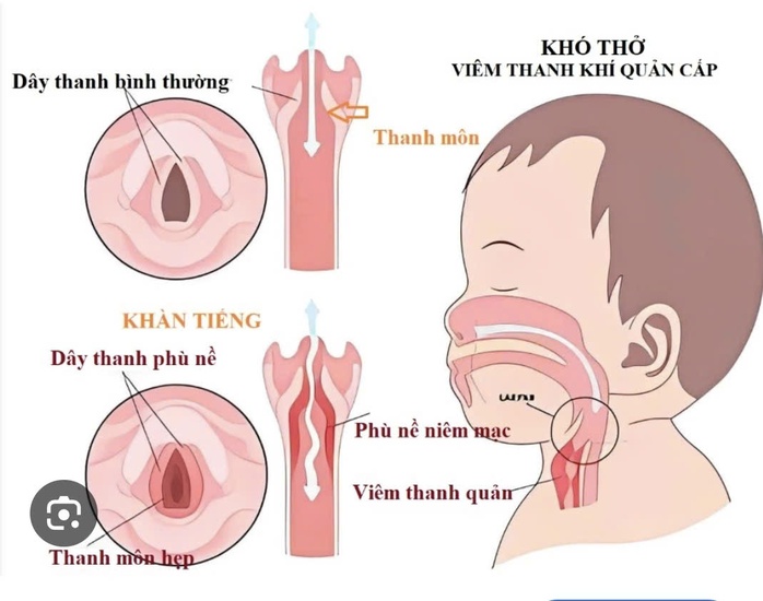 Sai lầm nguy hiểm nhất mà nhiều gia đình đang mắc phải là tự ý dùng kháng sinh và corticoid cho trẻ tại nhà mà không có chỉ định của bác sĩ