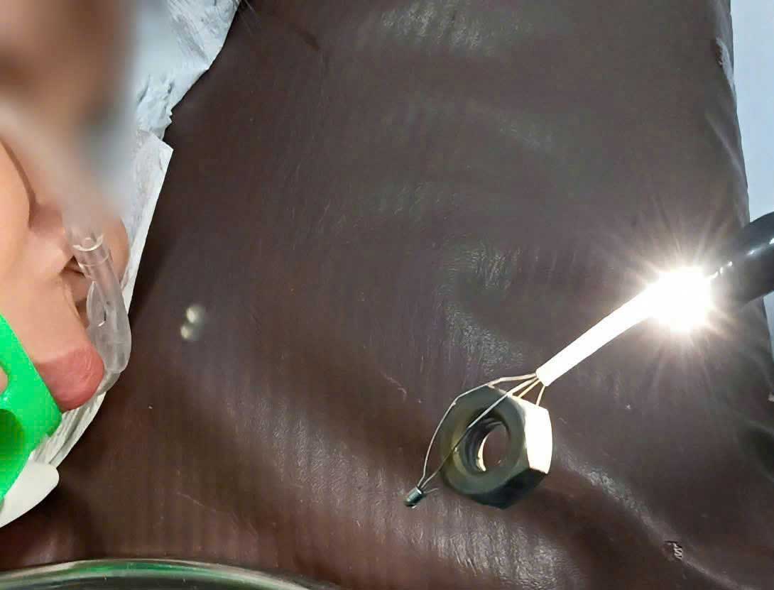 Các bác sĩ Khoa Nội soi BVĐK Vĩnh Long gắp dị vật con tán kim loại dài 2cm do bé trai 8 tuổi vô tình nuốt.