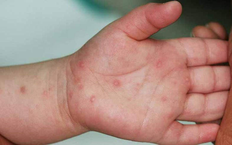 Trong 4 tuần gần đây, mỗi tuần cả nước ghi nhận khoảng 3000 ca mắc bệnh tay chân miệng


