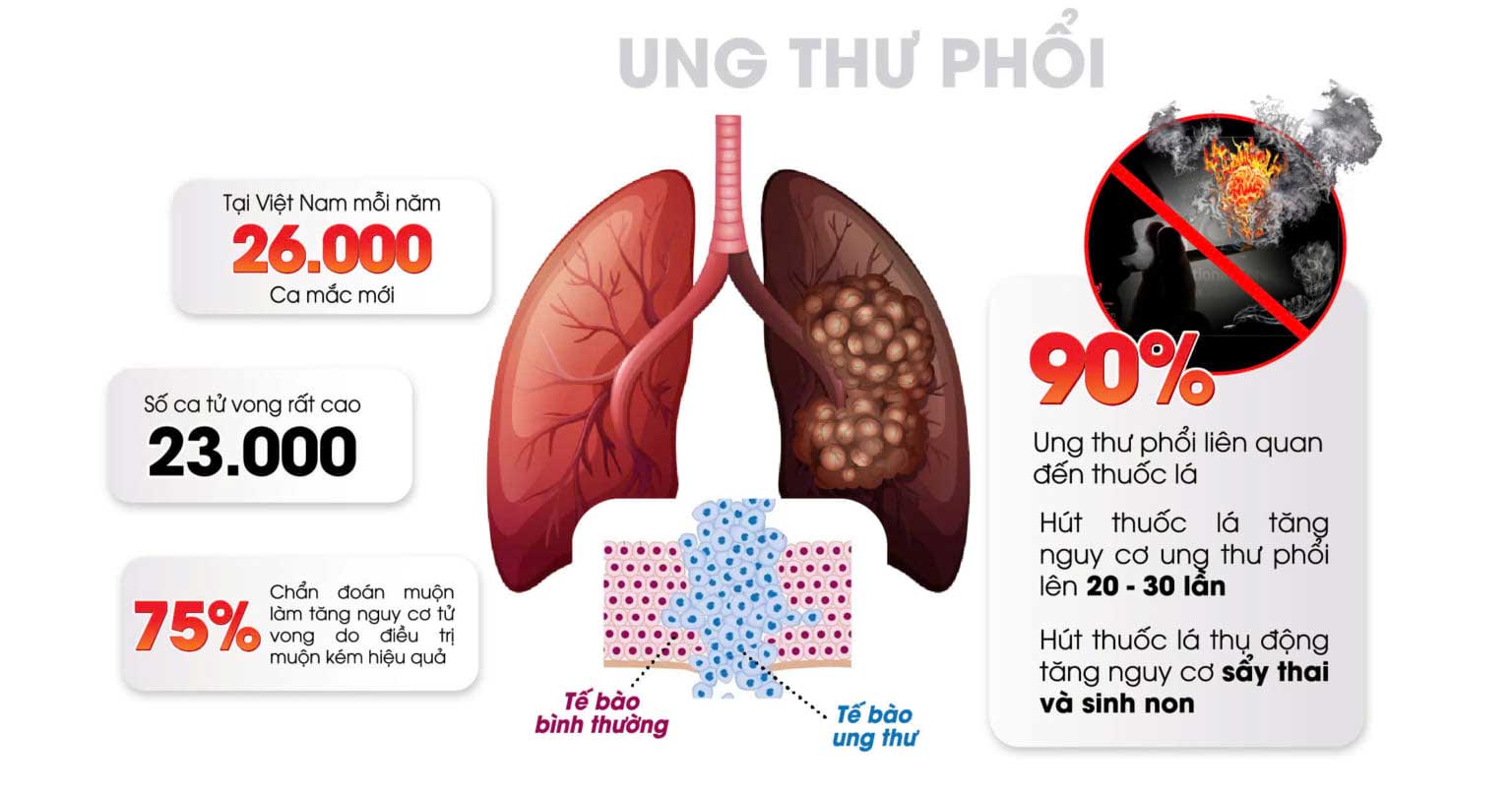 Hút thuốc lá làm tăng nguy cơ ung thư phổi lên 20-30 lần.