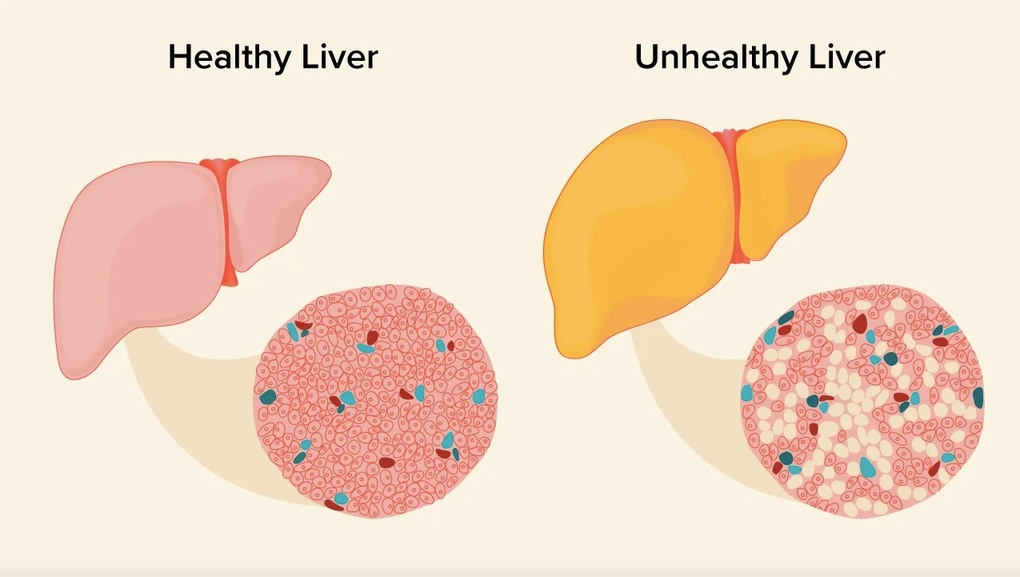 Hầu hết các trường hợp bị gan nhiễm mỡ không có triệu chứng (Ảnh:Healthline).