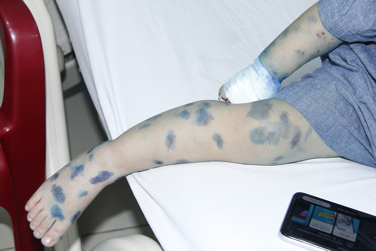 Bệnh tay chân miệng lây qua đường tiêu hóa, virus gây bệnh có nhiều trong vết loét, dịch bóng nước, nước bọt...