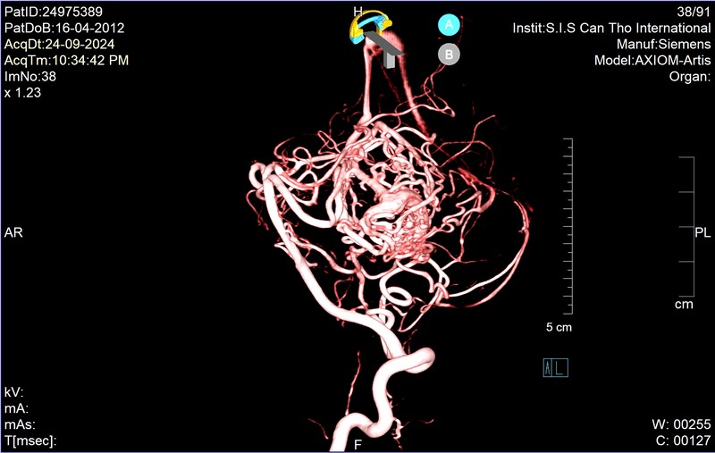 
Qua chụp DSA, phát hiện dị dạng thông động tĩnh mạch não bé trai K.C..