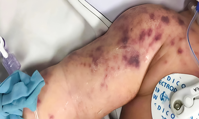 Các nốt ban tím lan rộng trên da của bệnh nhi 8,5 tháng tuổi từng điều trị tại Bệnh viện Nhi đồng 1.
ẢNH: BSCC