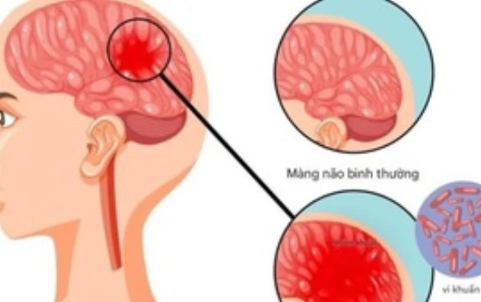 Khuyến cáo người dân chủ động phòng ngừa bệnh nhiễm trùng do não mô cầu