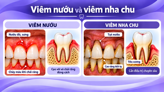 Sự khác biệt giữa viêm nướu và viêm nha chu.
Ảnh: L.Y TẠO TỪ CHATGPT