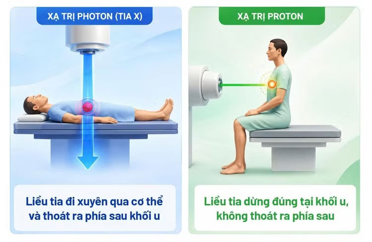 Xạ trị photon (tia X) đưa liều xạ vào khối u nhưng vẫn “đi xuyên qua” cơ thể gây tổn thương mô lành; còn xạ trị proton với tia năng lượng biết “dừng đúng chỗ” để tiêu diệt khối u an toàn.
