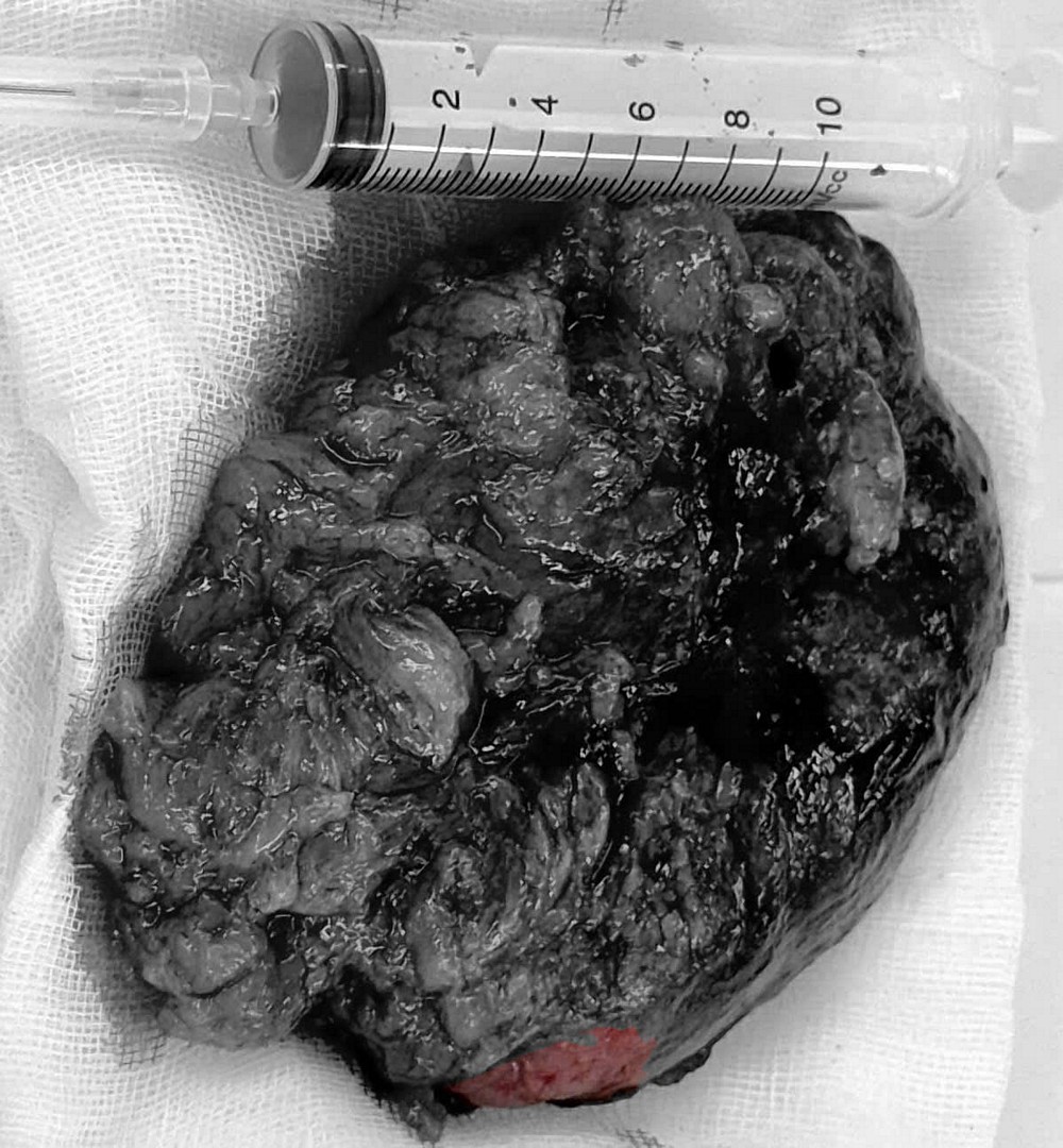 Khối u được lấy ra sau phẫu thuật.