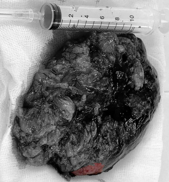 Bệnh viện Đa khoa Trà Vinh: Phẫu thuật thành công khối u màng não kích thước lớn 