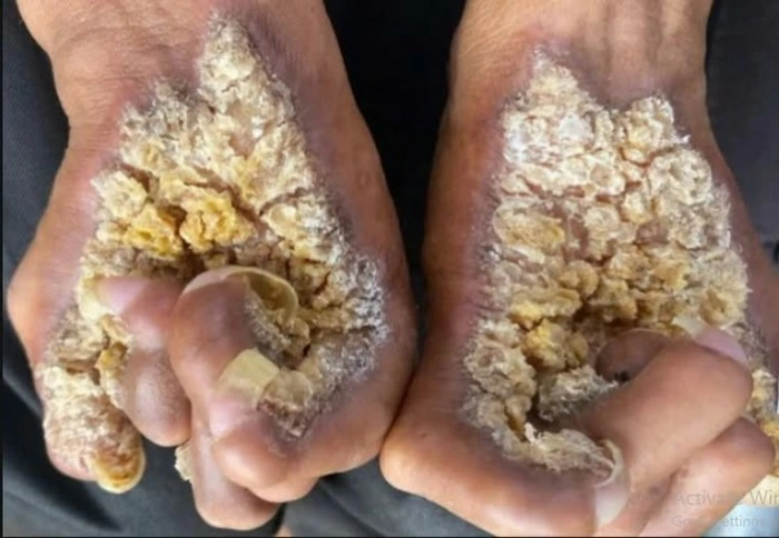 Người đàn ông thứ hai tại Việt Nam mắc hội chứng “người cây”