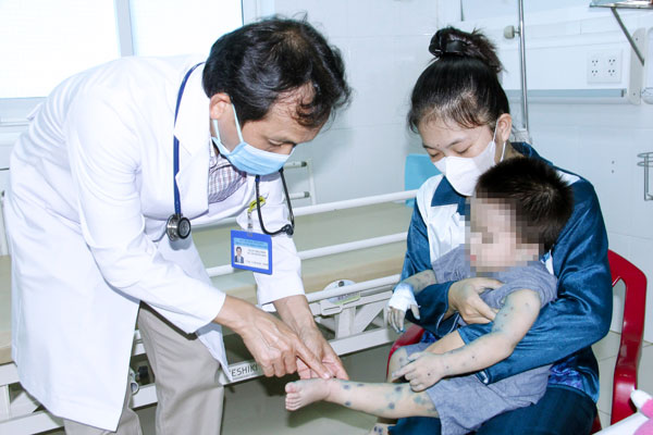 Trẻ mắc tay chân miệng điều trị tại Khoa Nhi BVĐK Vĩnh Long, tay chân thường nổi mụn bóng nước.

